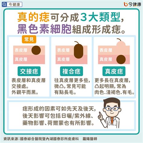 會長大的痣|是痣？皮膚癌？還是什麼？常見Q&A解惑！醫教揪出「假的痣」